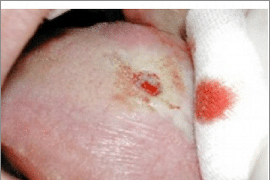 skin healing process