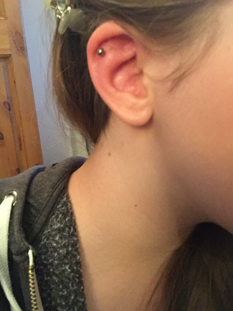 Comparison of healthy healed helix piercing and infected helix piercing