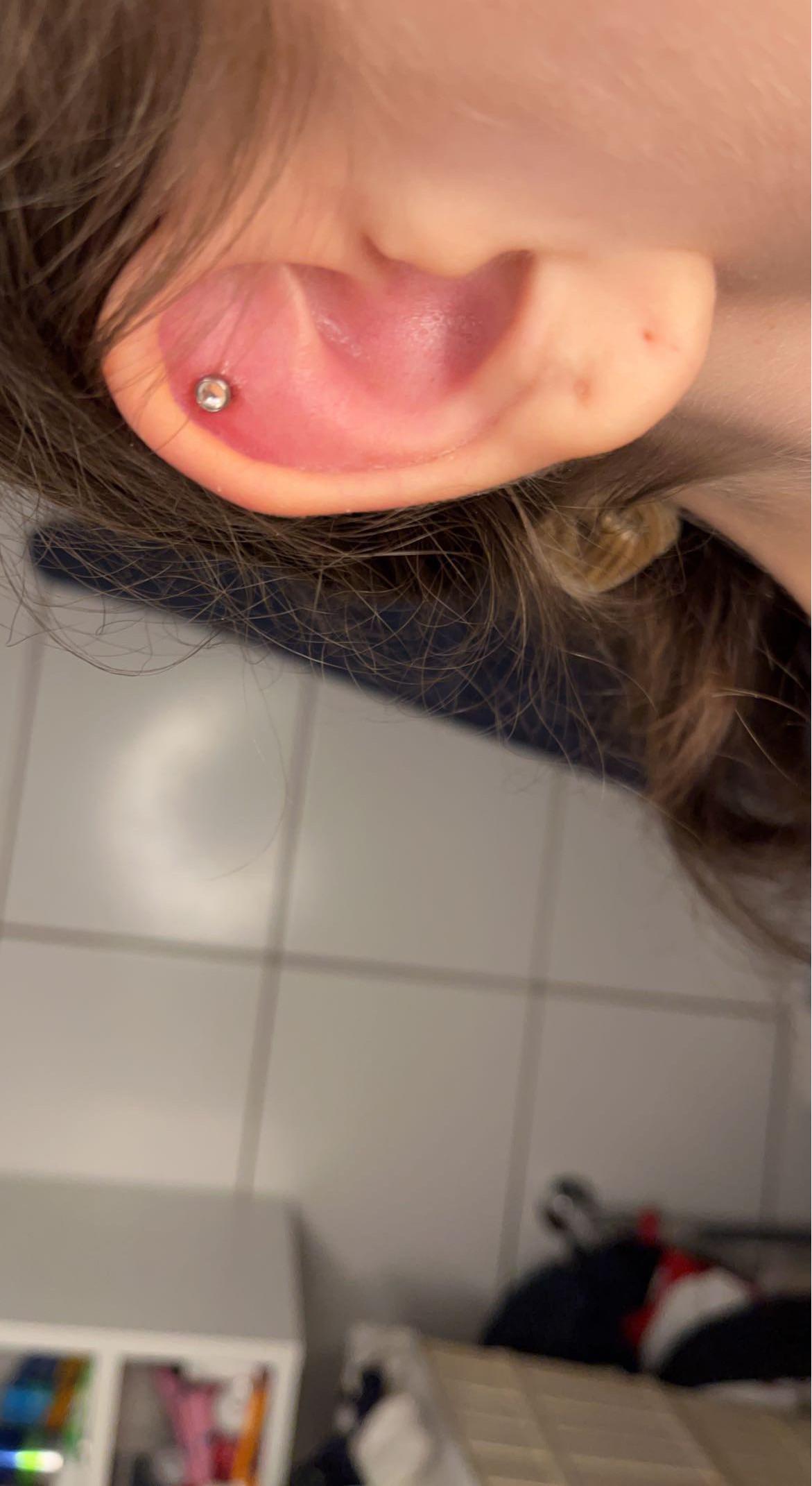 Comparison of a healthy helix piercing and an infected helix piercing